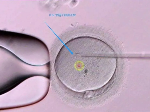 美国做试管移植三个胚胎生双胎的几率，这里可以了解